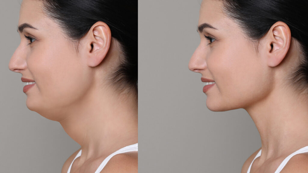 Double Chin Correction