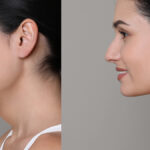 Double Chin Correction