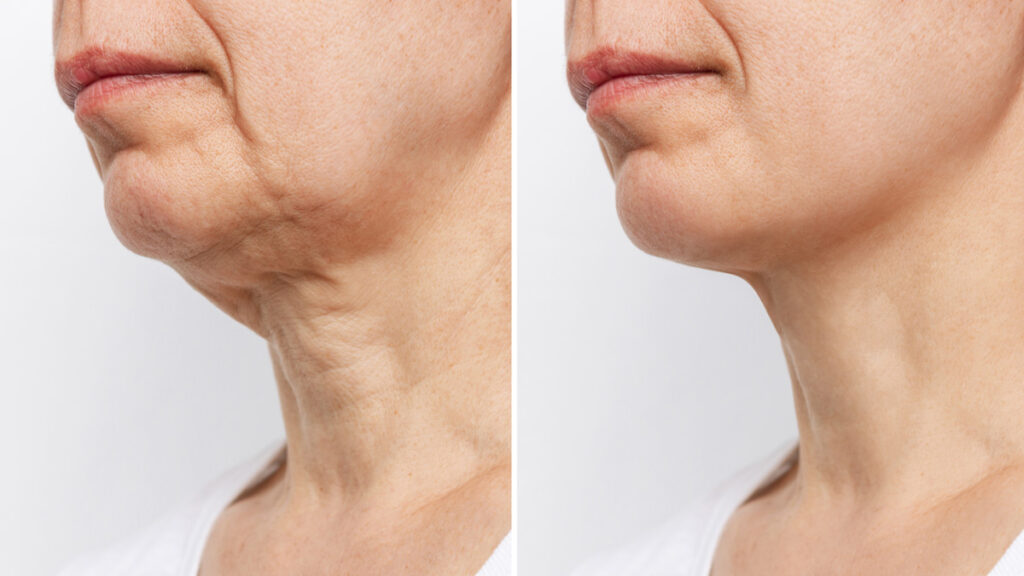 Neck Rejuvenation