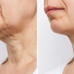 Neck Rejuvenation